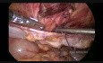 Laparoscopic Repair of Spigelian Hernia