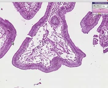 Gallbladder - Cholesterolosis