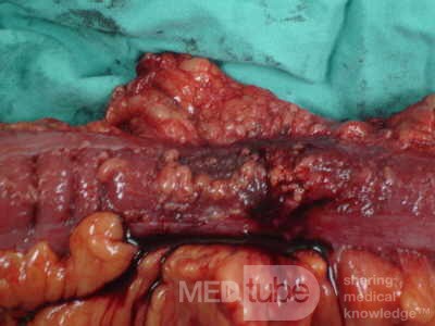 Adenocarcinoma of the Transverse Colon (14 of 15)