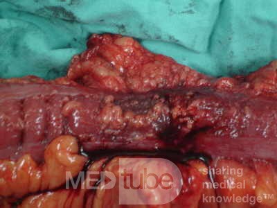 Adenocarcinoma of the Transverse Colon (14 of 15)