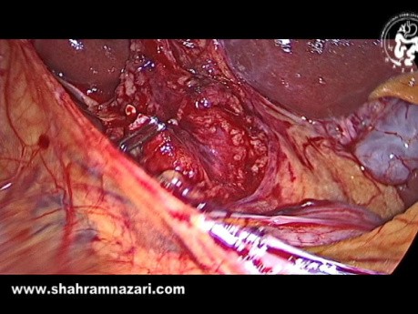 Splenosis