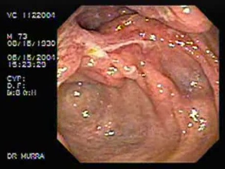 Crohn´s Disease of the Ileocecal Valve and Terminal Ileum (1 of 5)