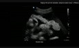 Ultrasound Staging with Corresponding Surgical Videos and Risk Prediction of Complications After Surgery for Advanced Ovarian Cancer