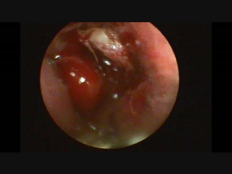 Pediatric Endoscopic DCR in Case of Presaccal Obstruction