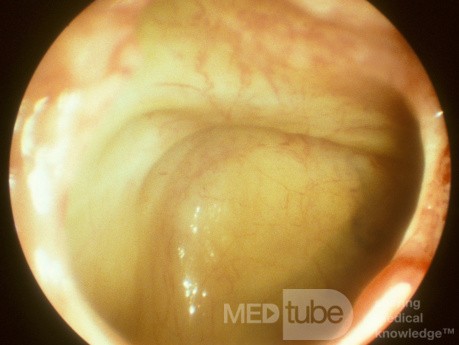 The Infraorbital Nerve Seen on the Roof of the Maxillary Sinus