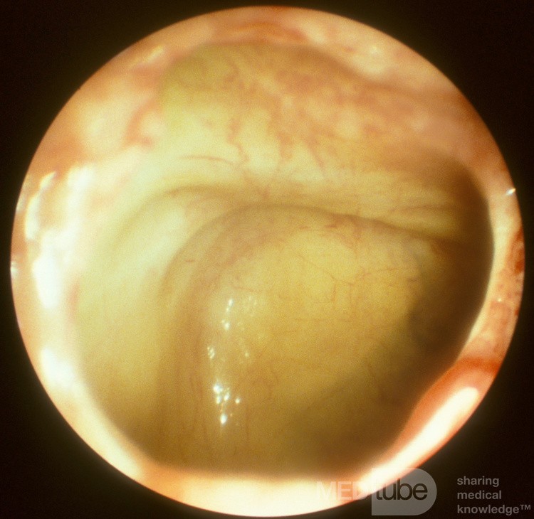The Infraorbital Nerve Seen on the Roof of the Maxillary Sinus