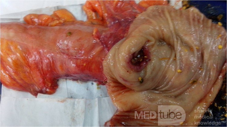 Cancer Sigmoid 