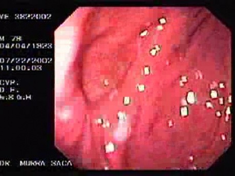 Ulcer of the Gastric Corpus (2 of 2)