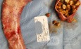 After Sleeve Gastrectomy and Cholecystectomy Surgery, the Removed Stomach part and Gallstones