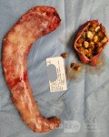 After Sleeve Gastrectomy and Cholecystectomy Surgery, the Removed Stomach part and Gallstones