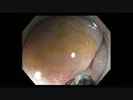 Colonoscopy Channel - EMR Defect Closure