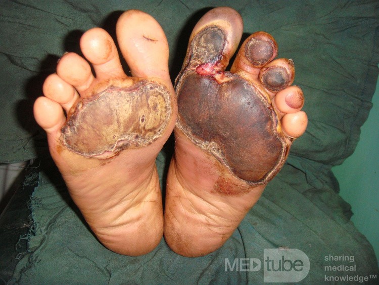 Diabetic foot Burn - sun burn