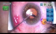 Pars Plana Technique for Malignant Glaucoma