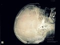 Acute Spontaneous Subdural Hemorrhage in the Subdural Space