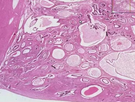 Endometrial polyp - Histopathology  - Endometrium