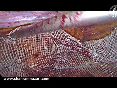 Laparoscopic Inguinal Hernia Tension Free Darn Mesh Repair