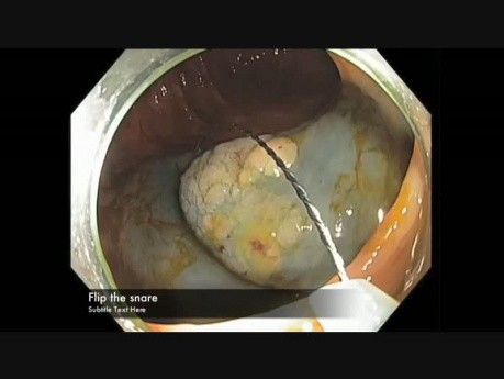 Colonoscopy Channel - EMR Of A Flat Lesion