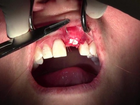 Suturing Technique, II - Extraction #9 with GBR-Socket Grafting