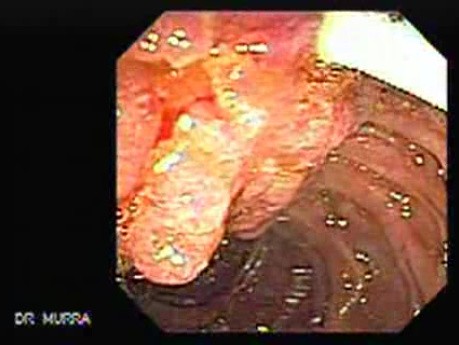 Adenocarcinoma of Papilla of Vater (3 of 5)