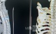 Cloward's Anterior Approach for AO Spine Type C Cervical Fracture with Brown Sequard Syndrome