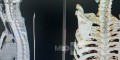 Cloward's Anterior Approach for AO Spine Type C Cervical Fracture with Brown Sequard Syndrome