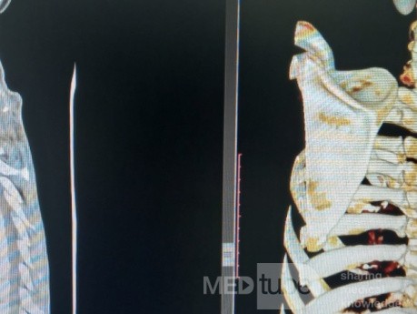 Cloward's Anterior Approach for AO Spine Type C Cervical Fracture with Brown Sequard Syndrome