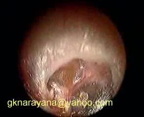 Retracted Tympanic Membrane Moving With Respiration