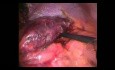 Diaphramatic Hernia with Necrotic Gastric Fundud in a Patient with a Previous Band Converted to the Possible Gastric Sleeve