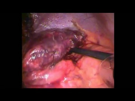 Diaphramatic Hernia with Necrotic Gastric Fundud in a Patient with a Previous Band Converted to the Possible Gastric Sleeve