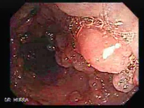 Familial Adenomatous Polyposis (17 of 36)