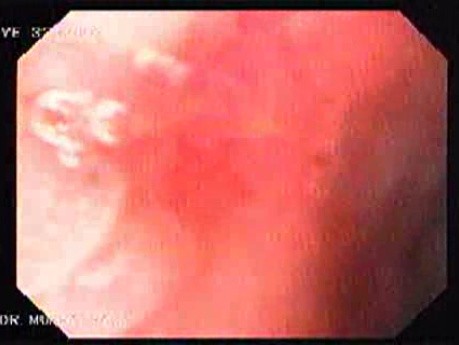 Ulcer on the Red Scar (1 of 2)
