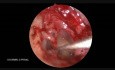 Two-Handed Endoscopic Stapedectomy