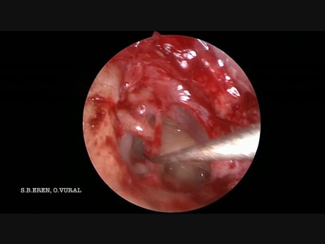 Two-Handed Endoscopic Stapedectomy