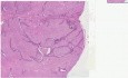 Fibroadenoma - Histopathology - Breast
