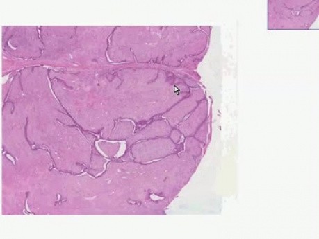 Fibroadenoma - Histopathology - Breast