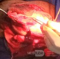 Meningocele in an 18-year-old patient
