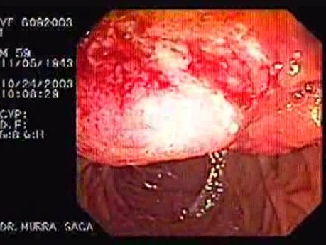 Adenocarcinoma of Papilla of Vater (1 of 4)