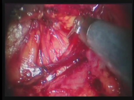 A Four Step Anatomic Approach To Right Robotic Adrenalectomy