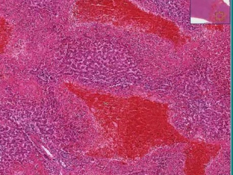 Traumatic hemorrhage