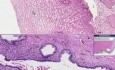 Squamous cell carcinoma - Histopathology - Cervix