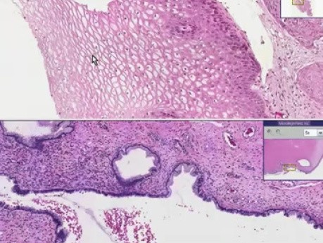 Squamous cell carcinoma - Histopathology - Cervix