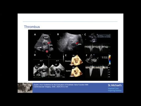 Echocardiographic Assessment of Prosthetic Aortic Valve Function