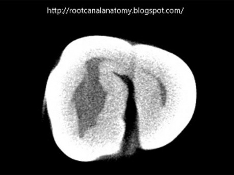 Maxillary Teeth - Root Canal Anatomy