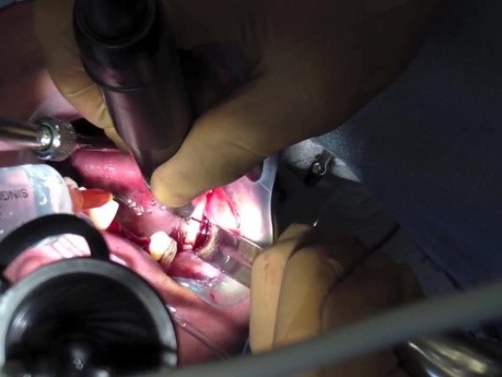 Bone Graft - Ramus Osteotomies And Harvesting Block