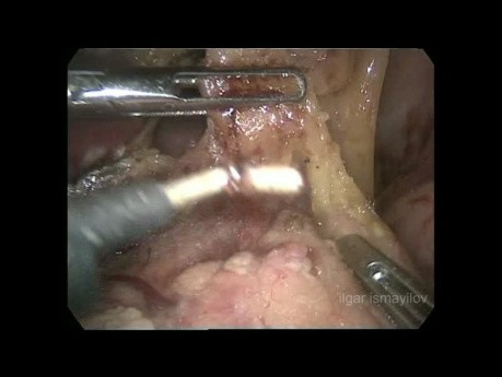 Laparoscopic Distal Subtotal Gastrectomy for Gastric Cancer