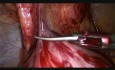 Laparoscopic Reversal of Hartmann Procedure