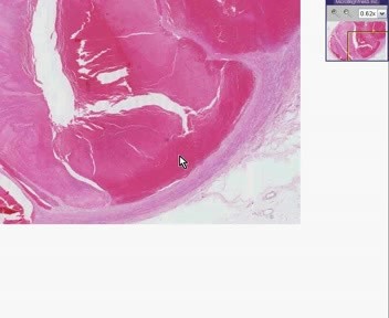 Popliteal Vein- Thrombosis