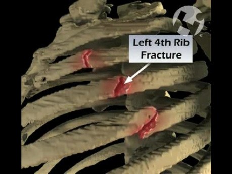 Rib Fractures