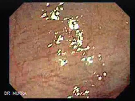 Polyp Inside Of A Diverticulum (9 of 12)