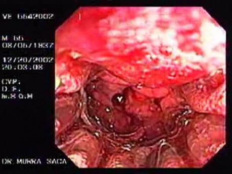 Zollinger- Ellison Syndrome - Gastric Ulcer with Gastrocolic Fistula (20 of 21)
